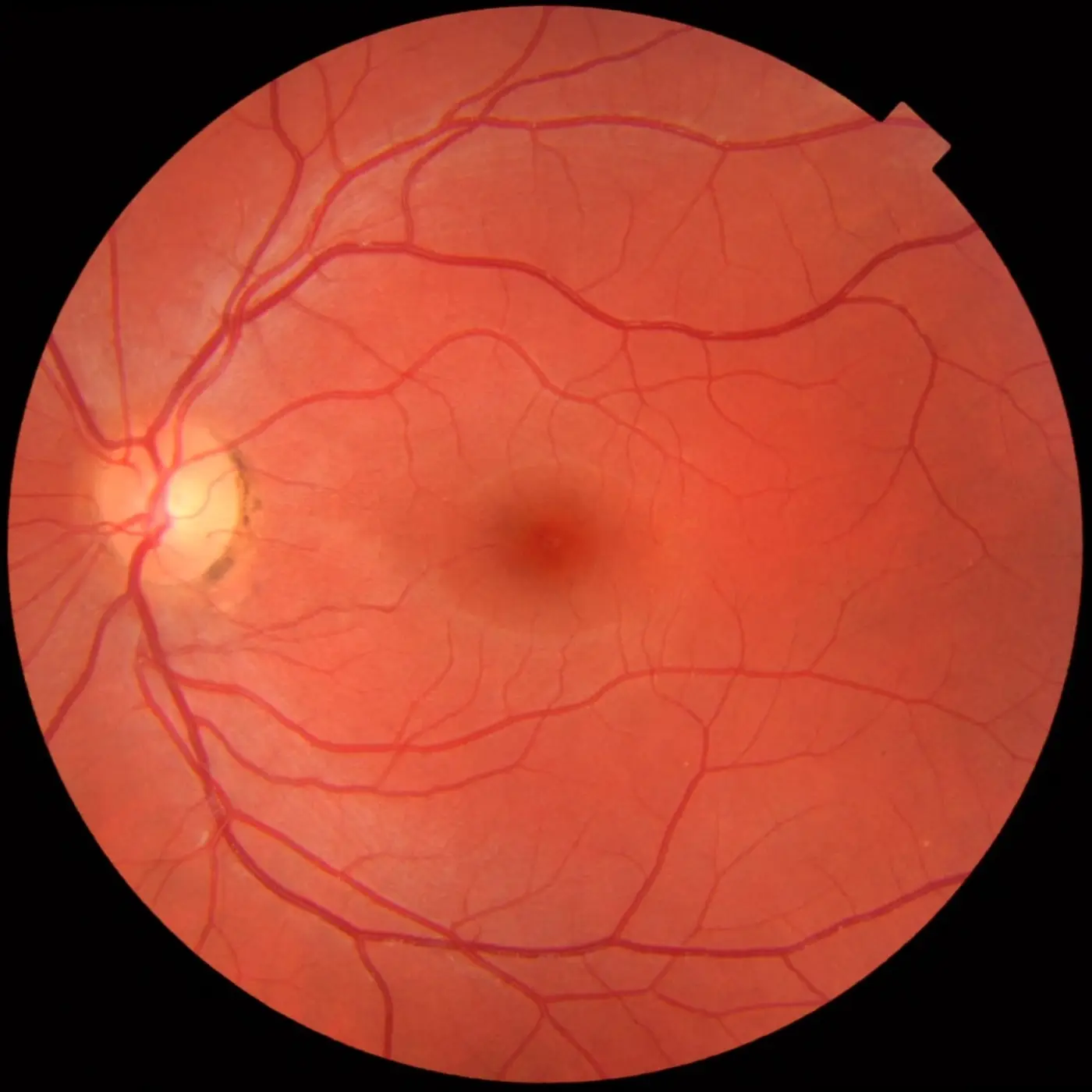 Photograph of a healthy human retina with blood vessels and the optic disc